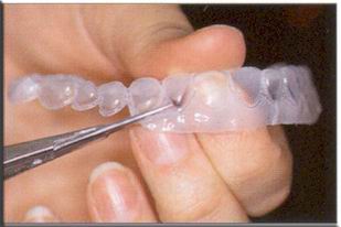 Scalloping Teeth Whitening Trays